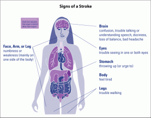 Female Stroke Signs - womenshealth.gov